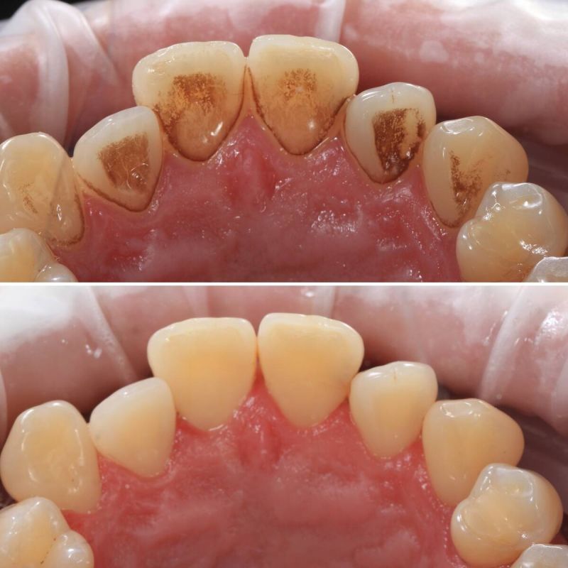 Как налет на зубах выдает вашу неряшливую гигиену: причины и решения