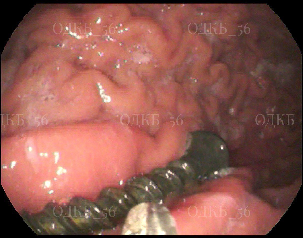 В Оренбурге 9-летний ребенок проглотил саморез В Оренбурге 9-летний ребенок проглотил саморез
