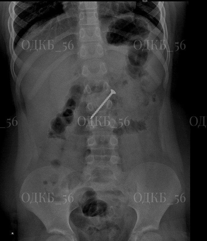 В Оренбурге 9-летний ребенок проглотил саморез В Оренбурге 9-летний ребенок проглотил саморез
