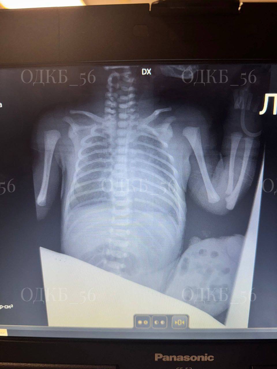 В Оренбурге хирурги спасли новорожденного с редкой патологией В Оренбурге хирурги спасли новорожденного с редкой патологией